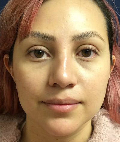 Rhinoplasty Before & After Gallery - Patient 397447 - Image 2