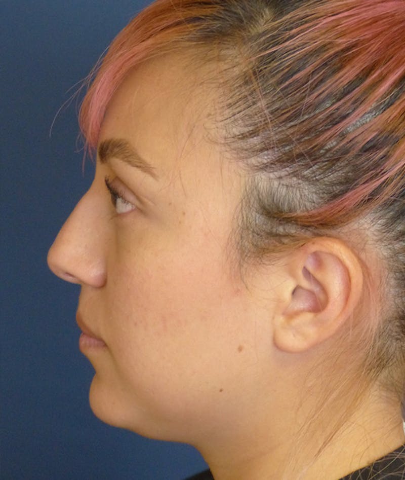Rhinoplasty Before & After Gallery - Patient 397447 - Image 3