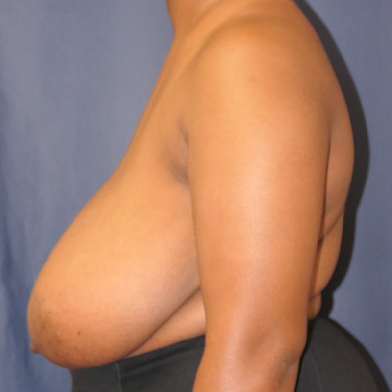 Breast Reduction Before & After Gallery - Patient 409436 - Image 9
