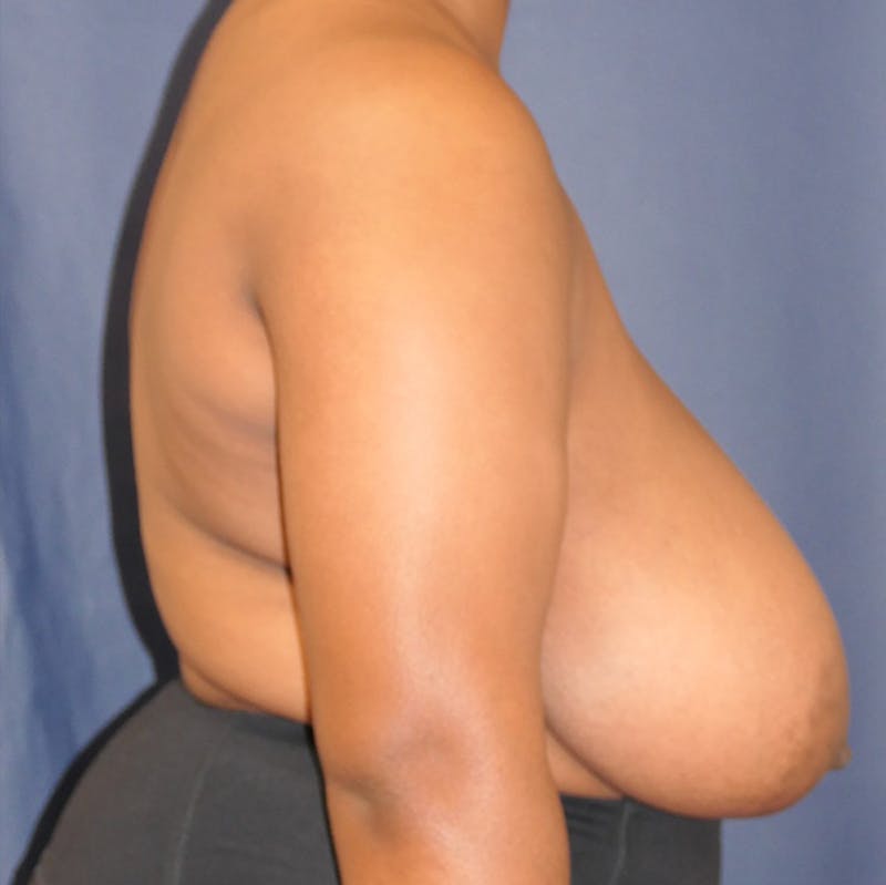 Breast Reduction Before & After Gallery - Patient 409436 - Image 5