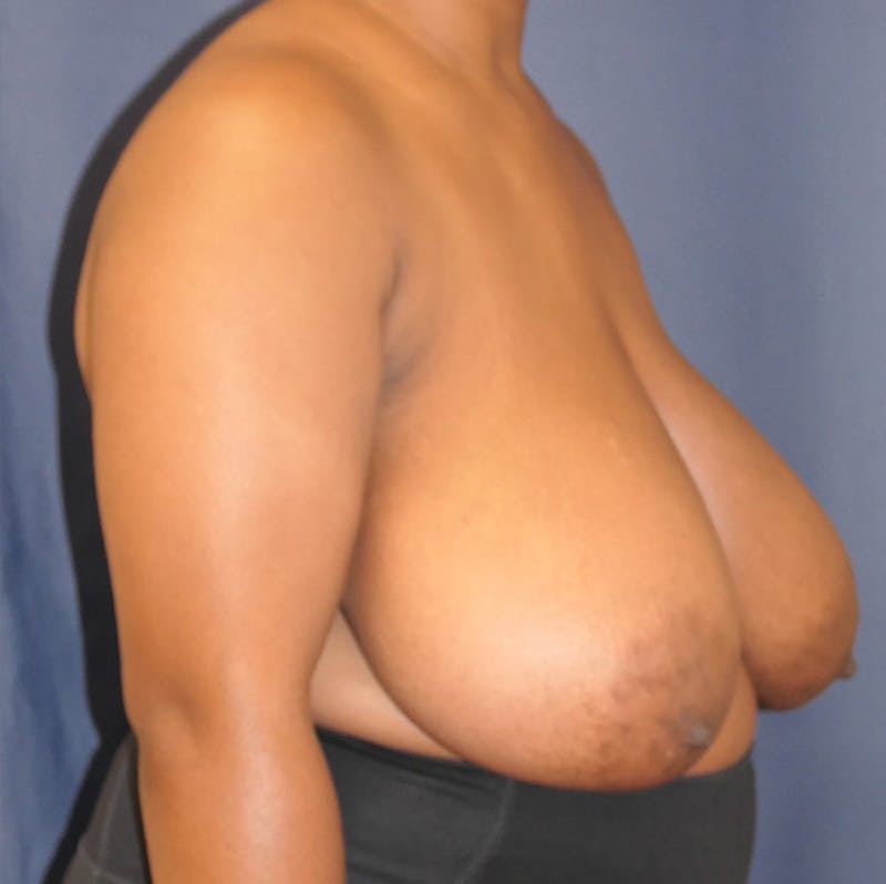Breast Reduction Before & After Gallery - Patient 409436 - Image 3