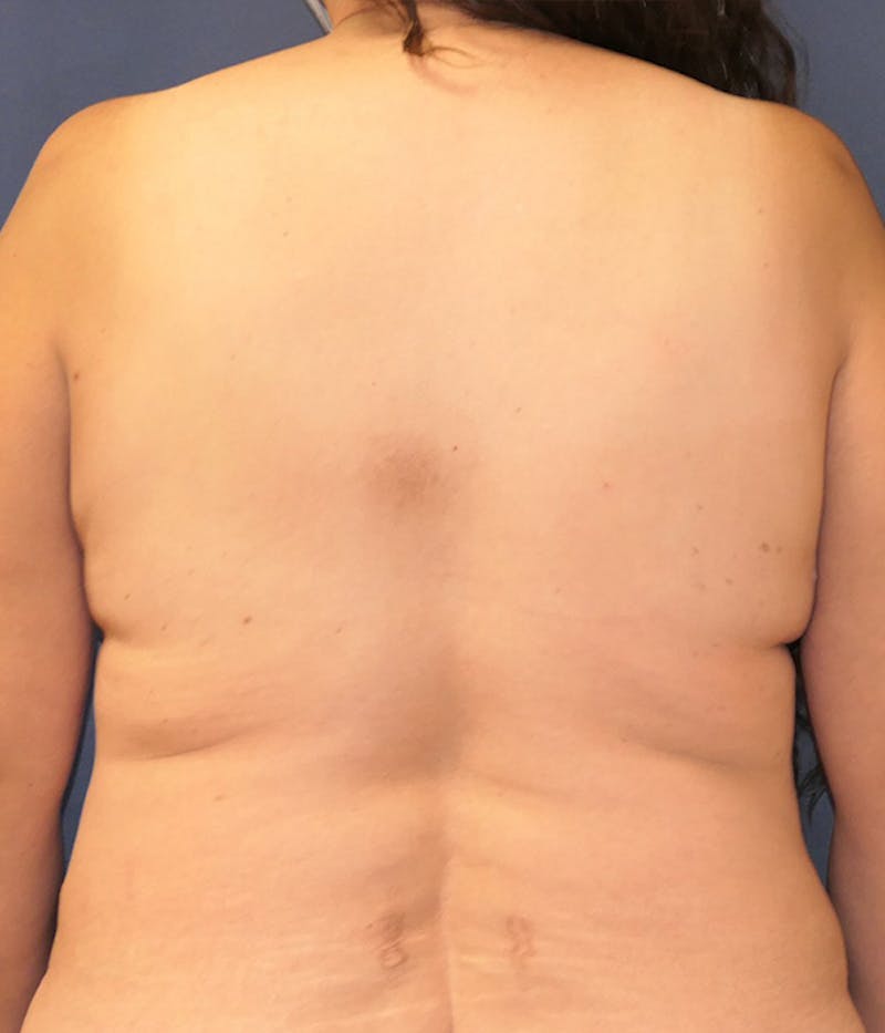 Breast Reconstruction with Autologous Tissue Before & After Gallery - Patient 209960 - Image 11