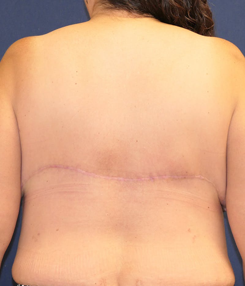 Breast Reconstruction with Autologous Tissue Before & After Gallery - Patient 209960 - Image 12