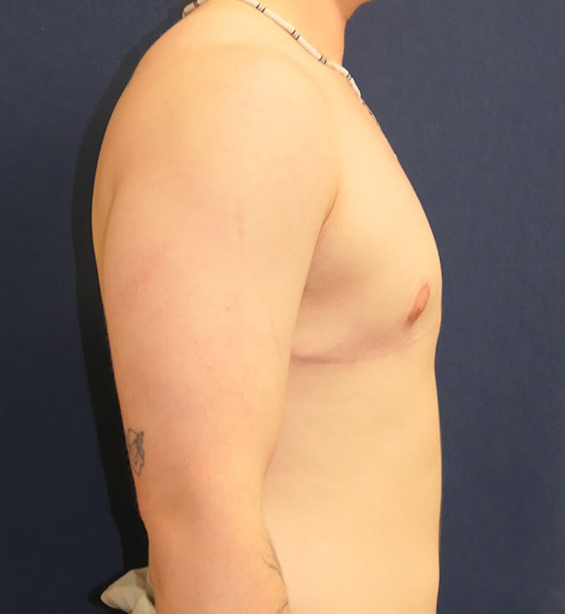 Masculinizing Surgery Before & After Gallery - Patient 341012 - Image 4