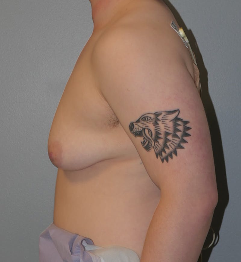 Masculinizing Surgery Before & After Gallery - Patient 341012 - Image 5