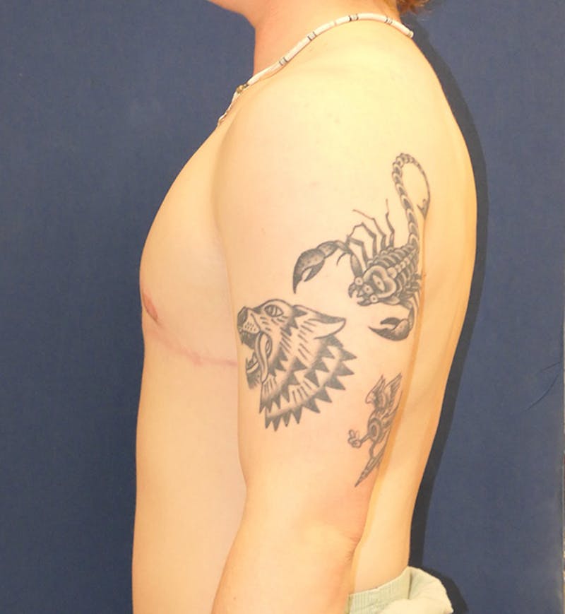 Masculinizing Surgery Before & After Gallery - Patient 341012 - Image 6
