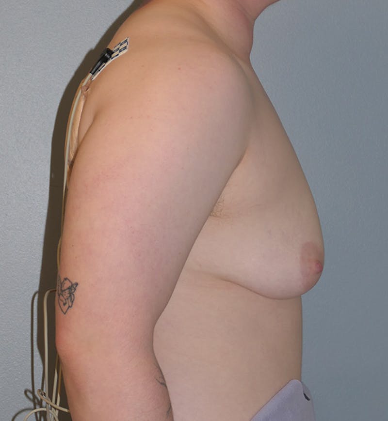 Masculinizing Surgery Before & After Gallery - Patient 341012 - Image 3