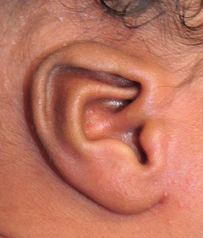 Ear Molding Before & After Gallery - Patient 373177 - Image 1