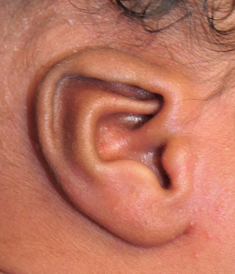 Ear Molding Before & After Gallery - Patient 373177 - Image 1