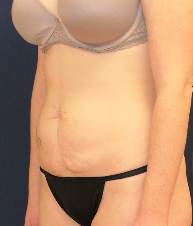 Tummy Tuck (Abdominoplasty) Before & After Gallery - Patient 284076 - Image 7