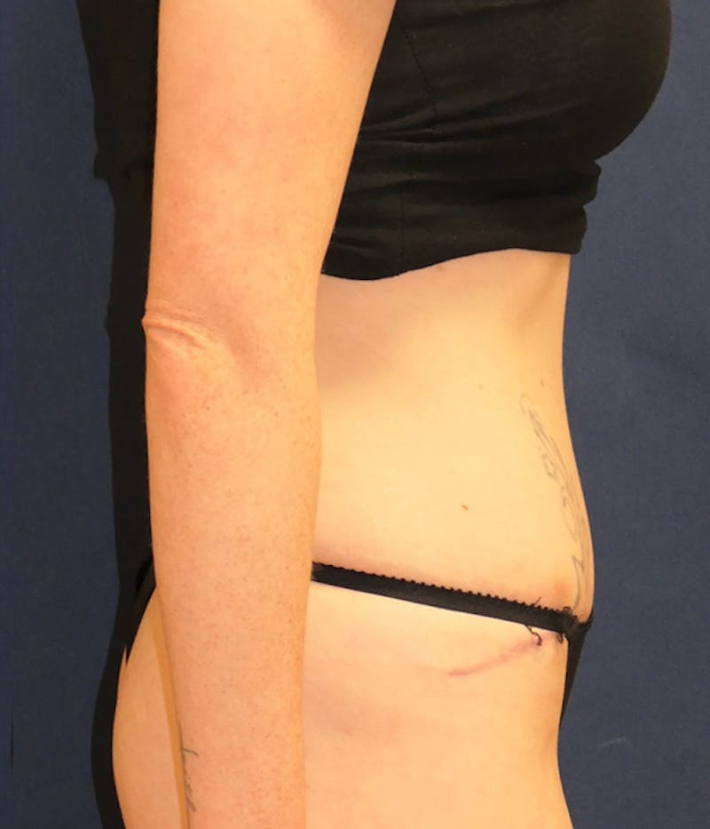 Tummy Tuck (Abdominoplasty) Before & After Gallery - Patient 284076 - Image 6