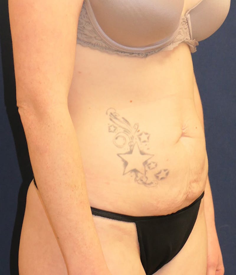 Tummy Tuck (Abdominoplasty) Before & After Gallery - Patient 284076 - Image 3