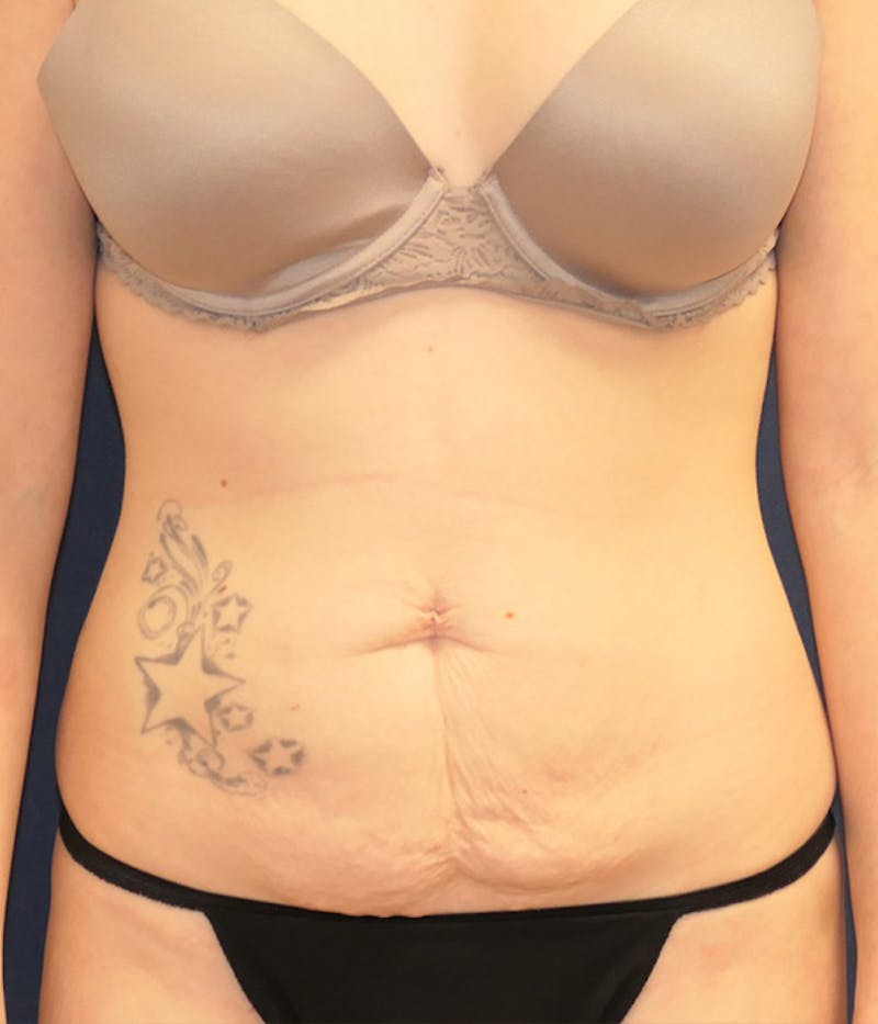 Tummy Tuck (Abdominoplasty) Before & After Gallery - Patient 284076 - Image 1