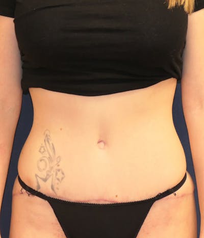 Tummy Tuck (Abdominoplasty) Before & After Gallery - Patient 284076 - Image 2