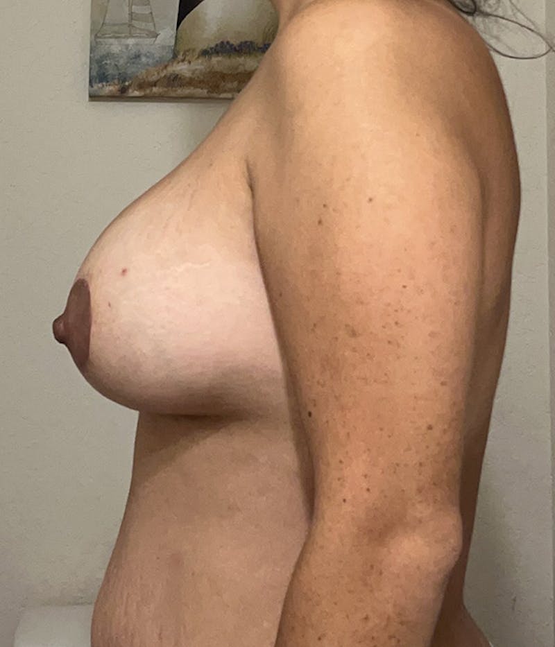 Breast Lift Before & After Gallery - Patient 129969 - Image 10