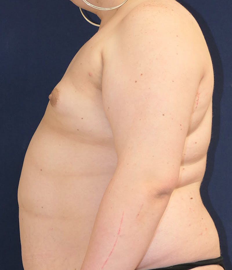 Breast Augmentation Before & After Gallery - Patient 204766 - Image 5