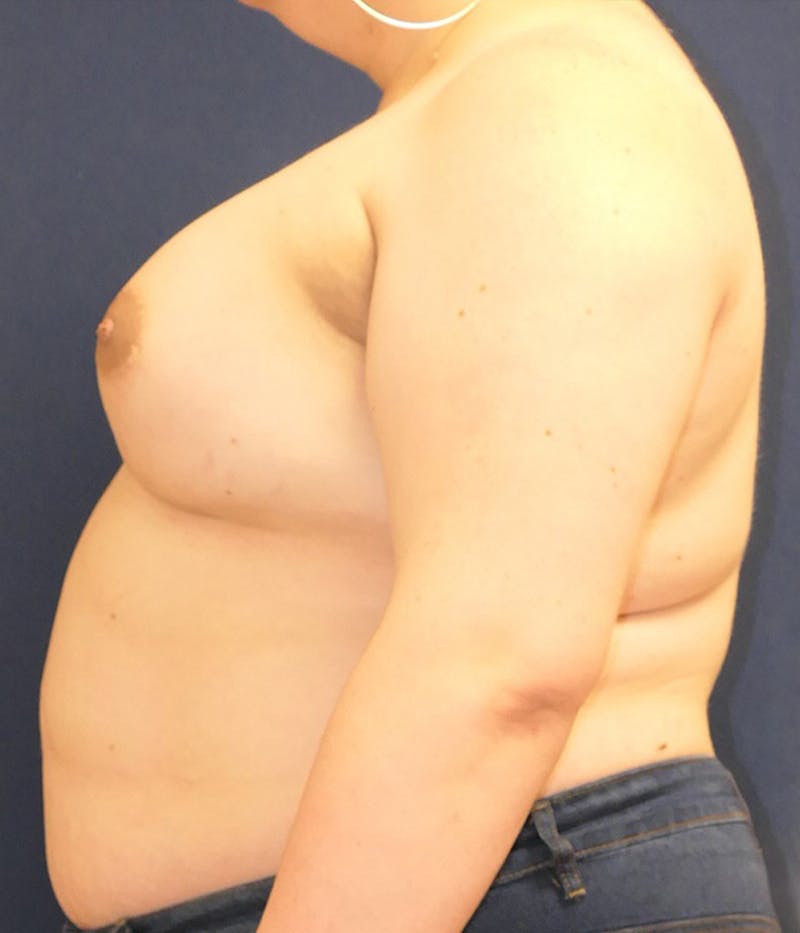 Breast Augmentation Before & After Gallery - Patient 204766 - Image 6