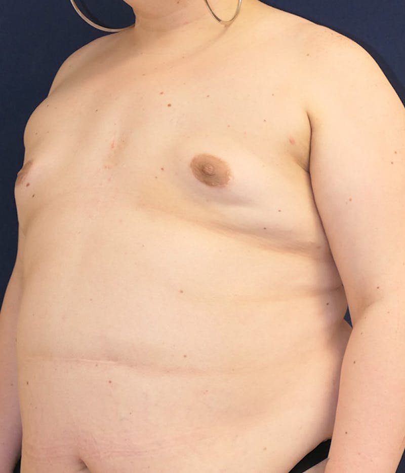 Breast Augmentation Before & After Gallery - Patient 204766 - Image 3
