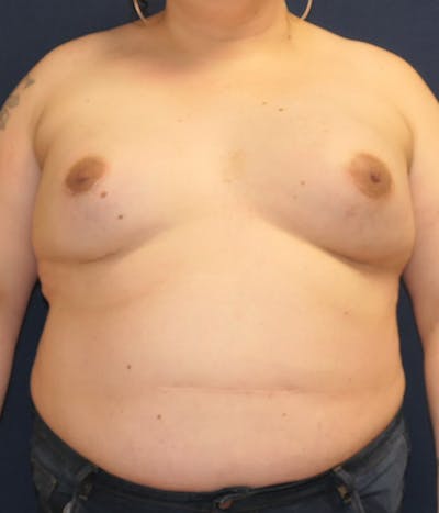 Breast Augmentation Before & After Gallery - Patient 204766 - Image 2