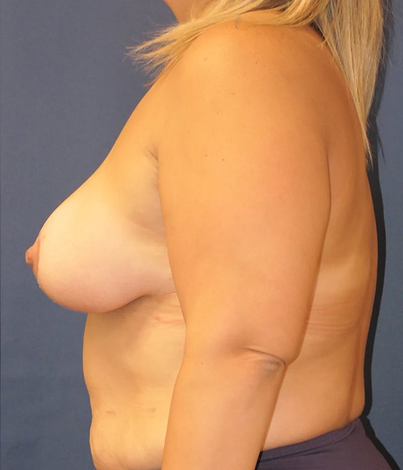 Breast Lift Before & After Gallery - Patient 958296 - Image 10