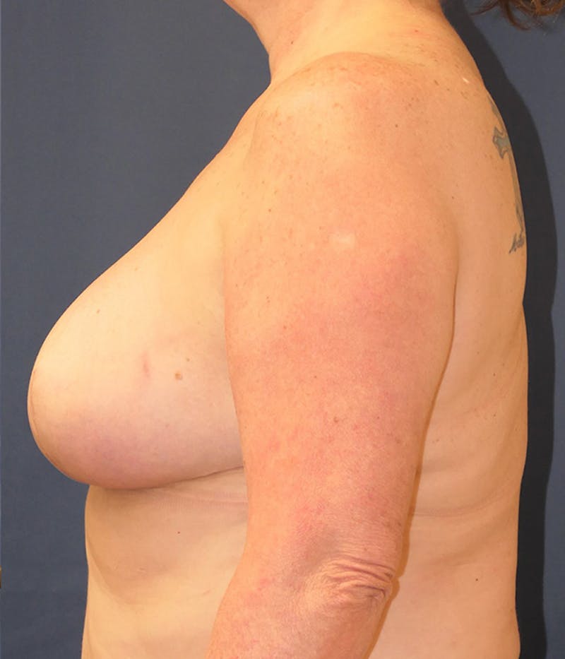 Breast Reconstruction with Implants Only Before & After Gallery - Patient 333417 - Image 10