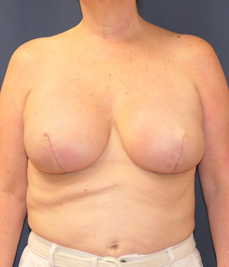 Breast Reconstruction with Implants Only Before & After Gallery - Patient 333417 - Image 2