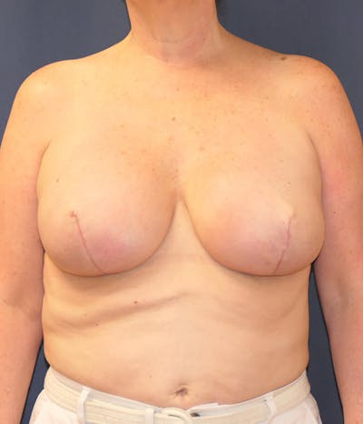 Breast Reconstruction with Implants Only Before & After Gallery - Patient 333417 - Image 2