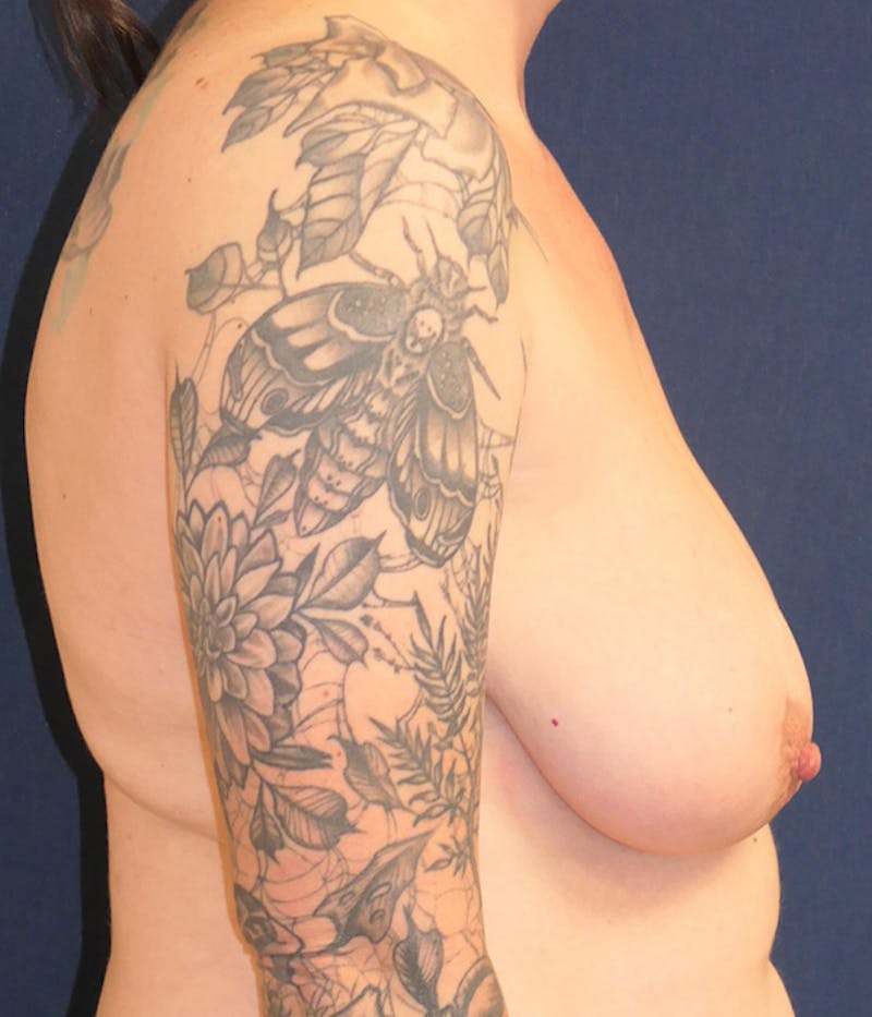 Breast Lift Before & After Gallery - Patient 377580 - Image 5