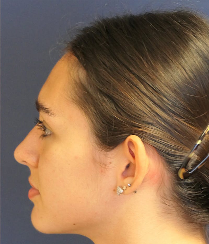 Ear Pinning (Otoplasty) Before & After Gallery - Patient 193280 - Image 9