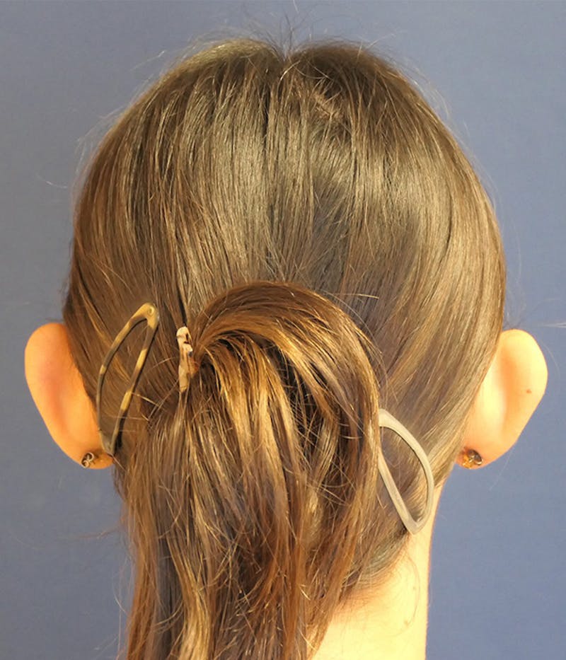 Ear Pinning (Otoplasty) Before & After Gallery - Patient 193280 - Image 7