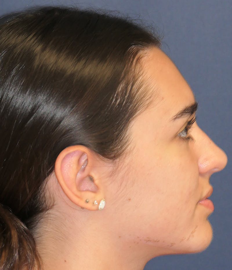 Ear Pinning (Otoplasty) Before & After Gallery - Patient 193280 - Image 4