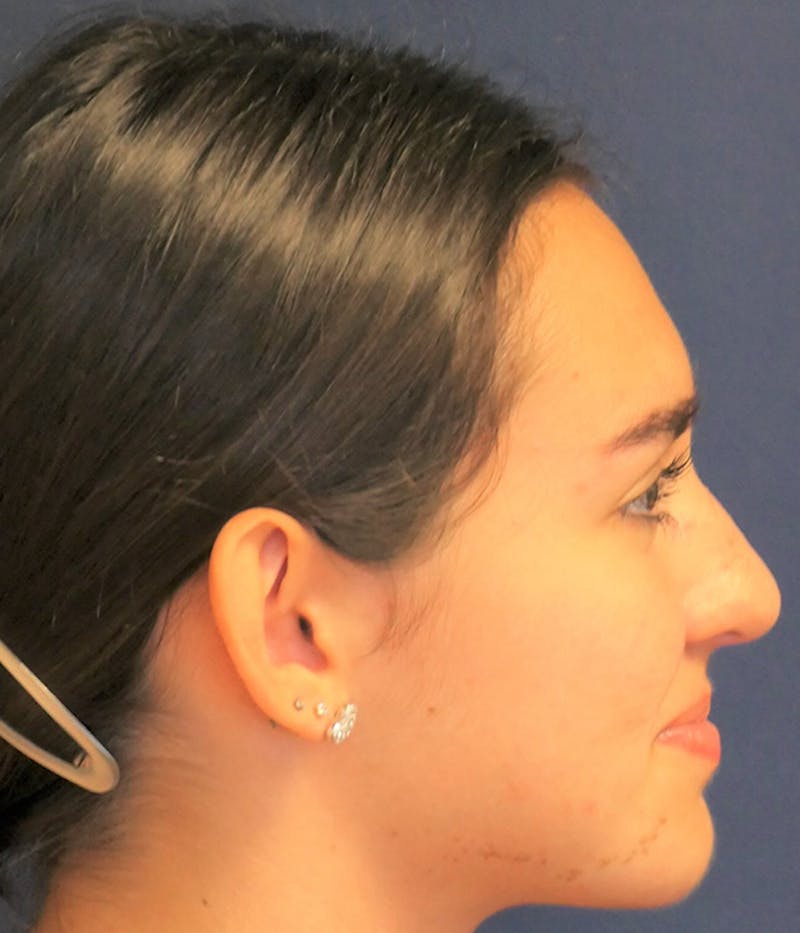 Ear Pinning (Otoplasty) Before & After Gallery - Patient 193280 - Image 3