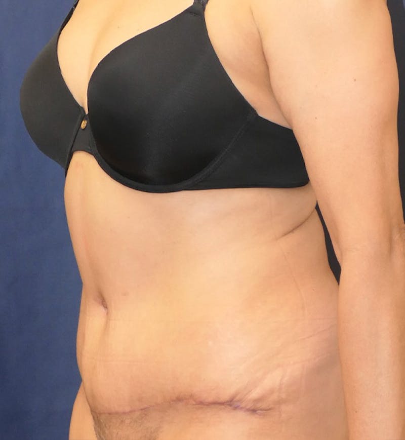 Tummy Tuck (Abdominoplasty) Before & After Gallery - Patient 343772 - Image 4