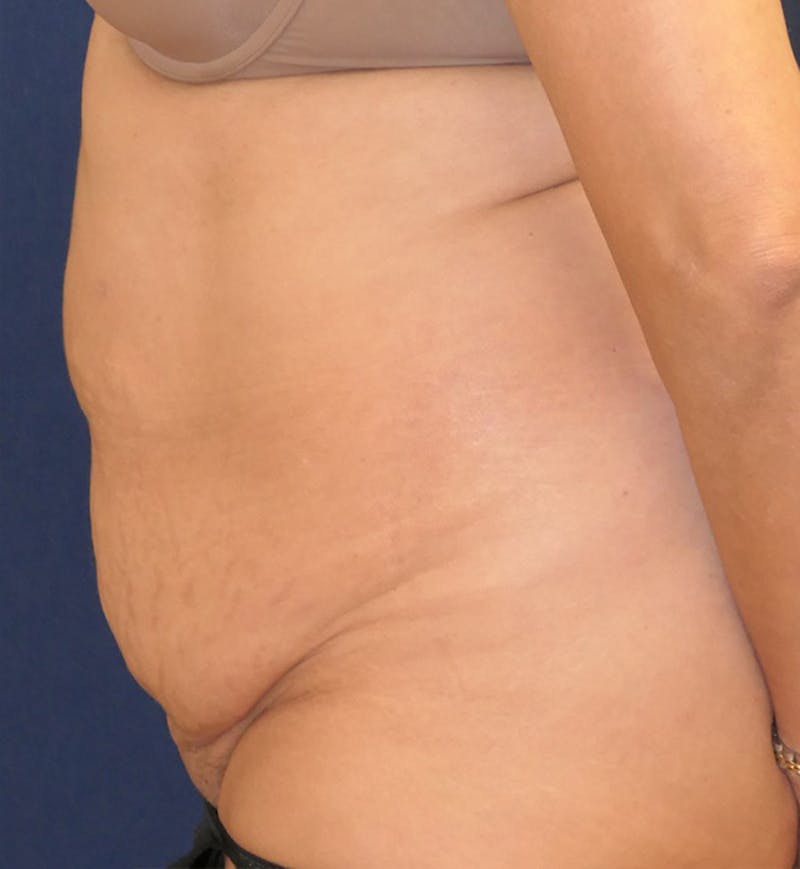 Tummy Tuck (Abdominoplasty) Before & After Gallery - Patient 343772 - Image 5