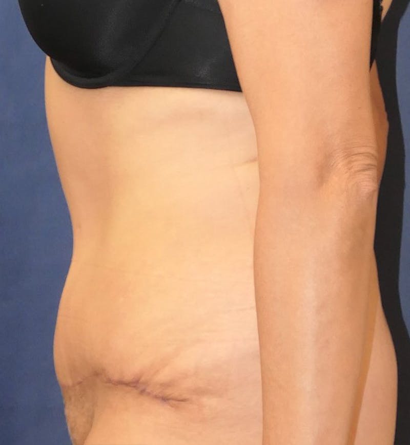 Tummy Tuck (Abdominoplasty) Before & After Gallery - Patient 343772 - Image 6