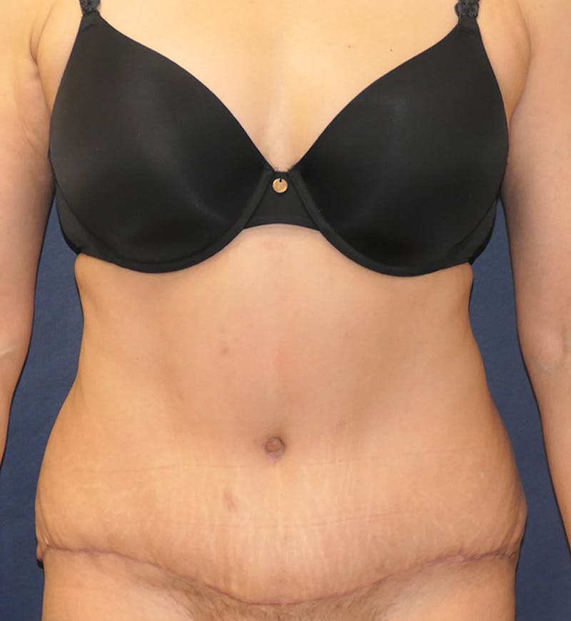 Tummy Tuck (Abdominoplasty) Before & After Gallery - Patient 343772 - Image 2