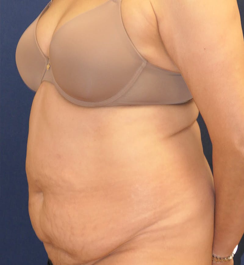Tummy Tuck (Abdominoplasty) Before & After Gallery - Patient 343772 - Image 3