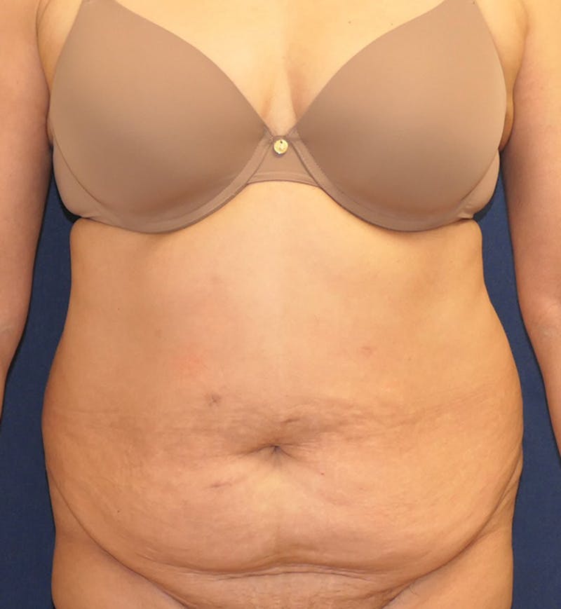 Tummy Tuck (Abdominoplasty) Before & After Gallery - Patient 343772 - Image 1