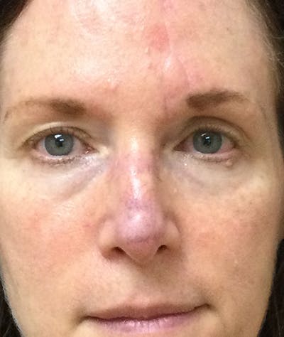 Miscellaneous Before & After Gallery - Patient 263256 - Image 2