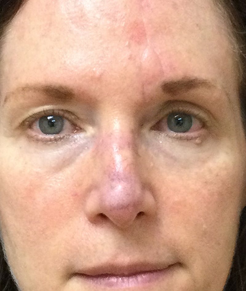 Miscellaneous Before & After Gallery - Patient 263256 - Image 2