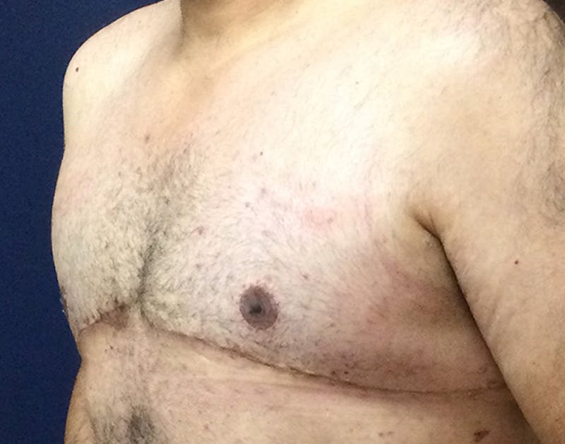 Male Subcutaneous Mastectomy (Gynecomastia) Before & After Gallery - Patient 621895 - Image 8