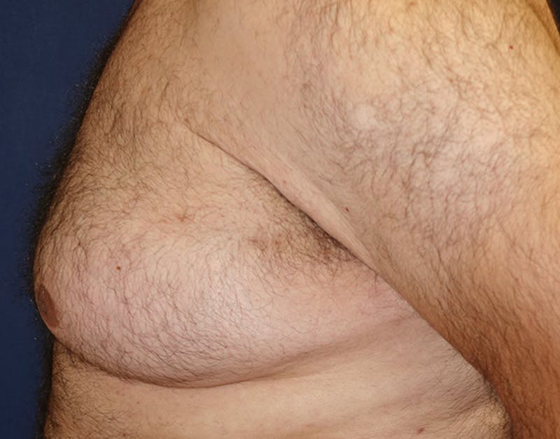 Male Subcutaneous Mastectomy (Gynecomastia) Before & After Gallery - Patient 621895 - Image 9