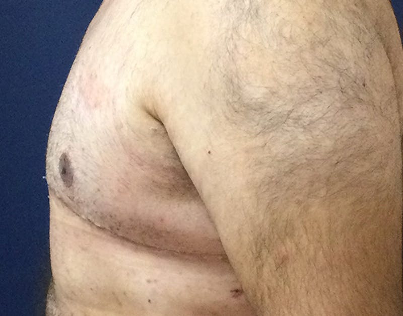 Male Subcutaneous Mastectomy (Gynecomastia) Before & After Gallery - Patient 621895 - Image 10