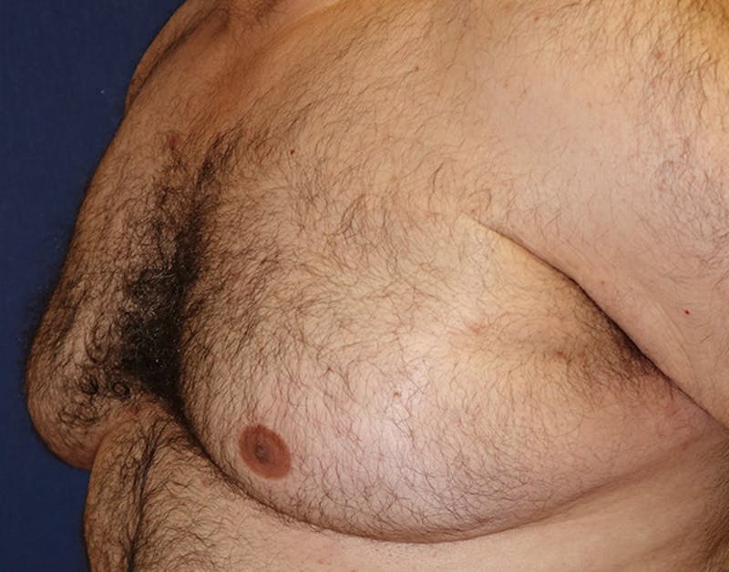 Male Subcutaneous Mastectomy (Gynecomastia) Before & After Gallery - Patient 621895 - Image 7