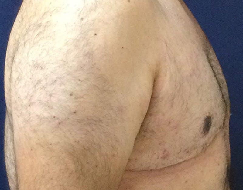Male Subcutaneous Mastectomy (Gynecomastia) Before & After Gallery - Patient 621895 - Image 6