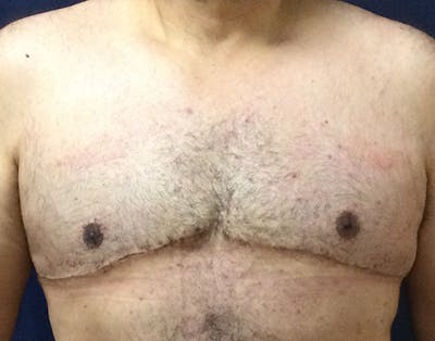 Male Subcutaneous Mastectomy (Gynecomastia) Before & After Gallery - Patient 621895 - Image 2