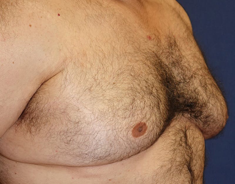 Male Subcutaneous Mastectomy (Gynecomastia) Before & After Gallery - Patient 621895 - Image 3