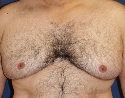 Male Subcutaneous Mastectomy (Gynecomastia) Before & After Gallery - Patient 621895 - Image 1