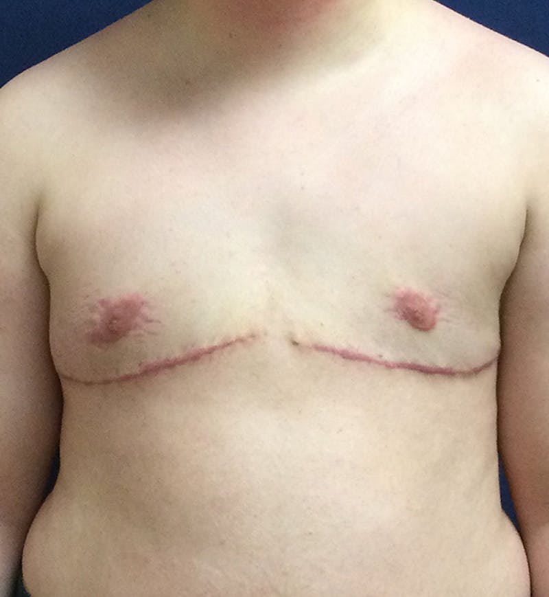 Masculinizing Surgery Before & After Gallery - Patient 333757 - Image 2