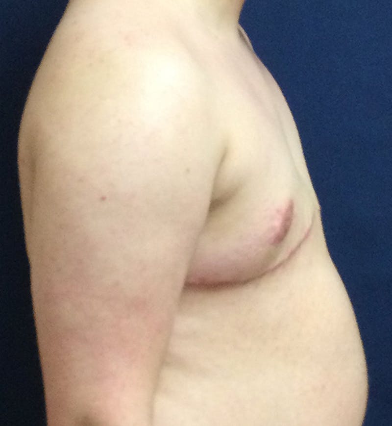 Masculinizing Surgery Before & After Gallery - Patient 333757 - Image 4